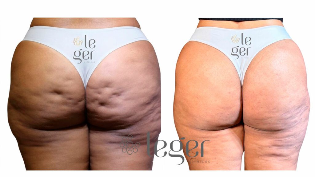 Resultado Antes e depois do tratamento para celulite com protocolo da GoldIncision