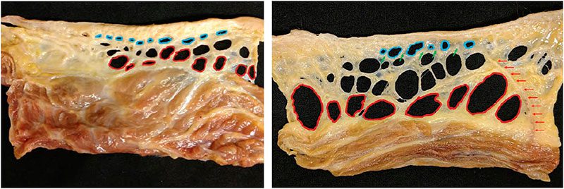 Diferença entre as fibras que formam a celulite no homem e na mulher