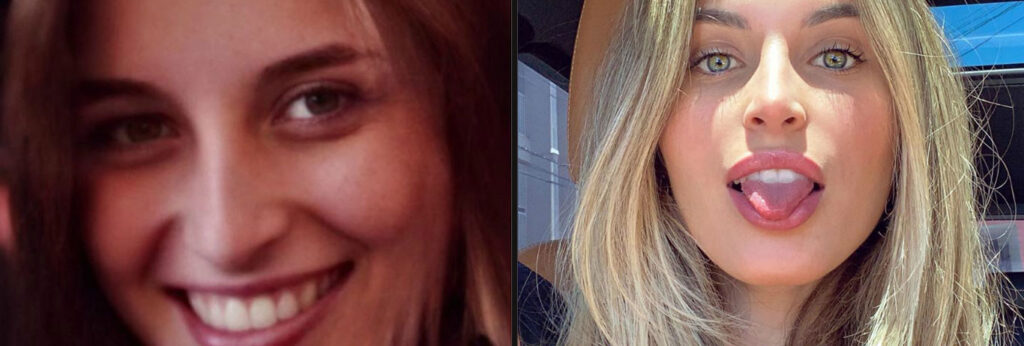 mulher loira mostra seu antes e depois da harmonização facial onde empinou o nariz e aumentou os lábios