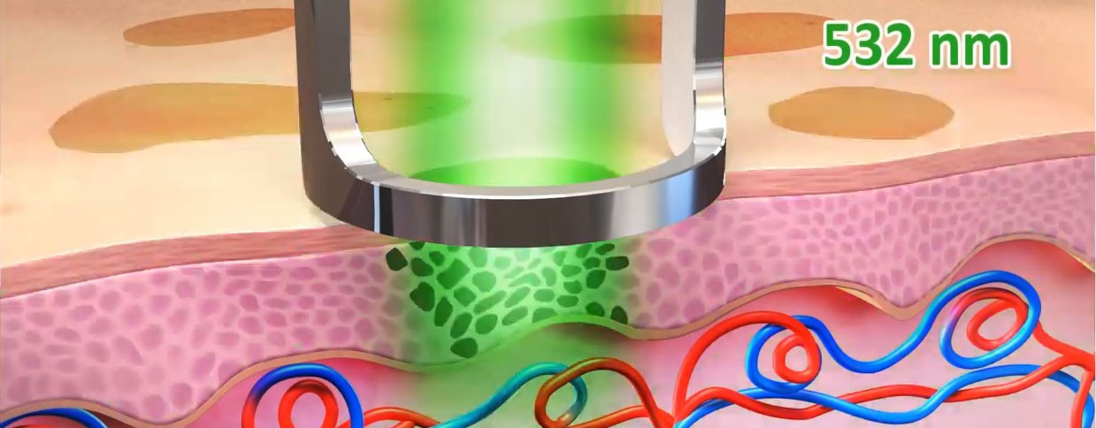 É possível ter resultados naturais com a harmonização facial?