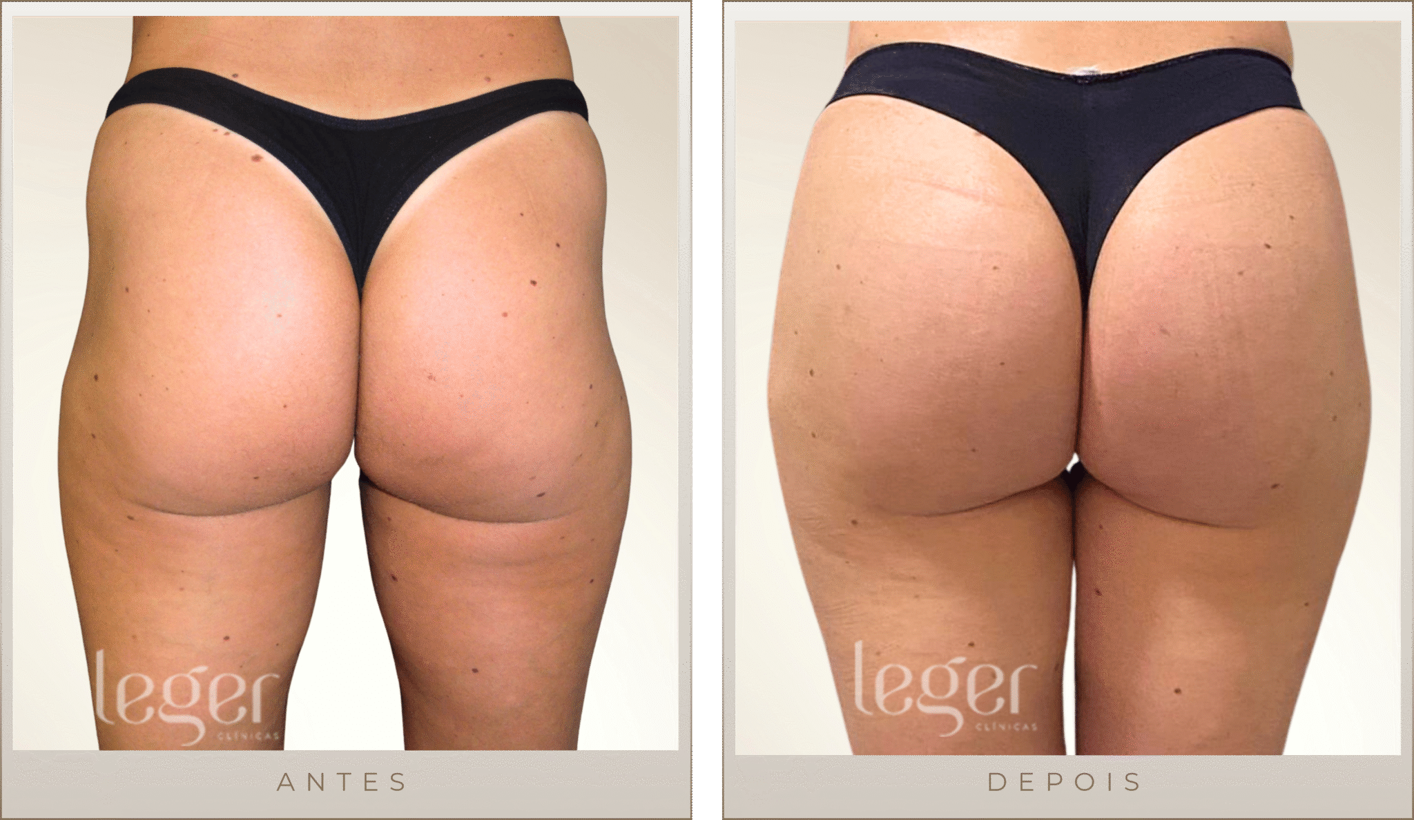 Rejuvenescimento de glúteos: Como tratar a flacidez e perda de volume ...